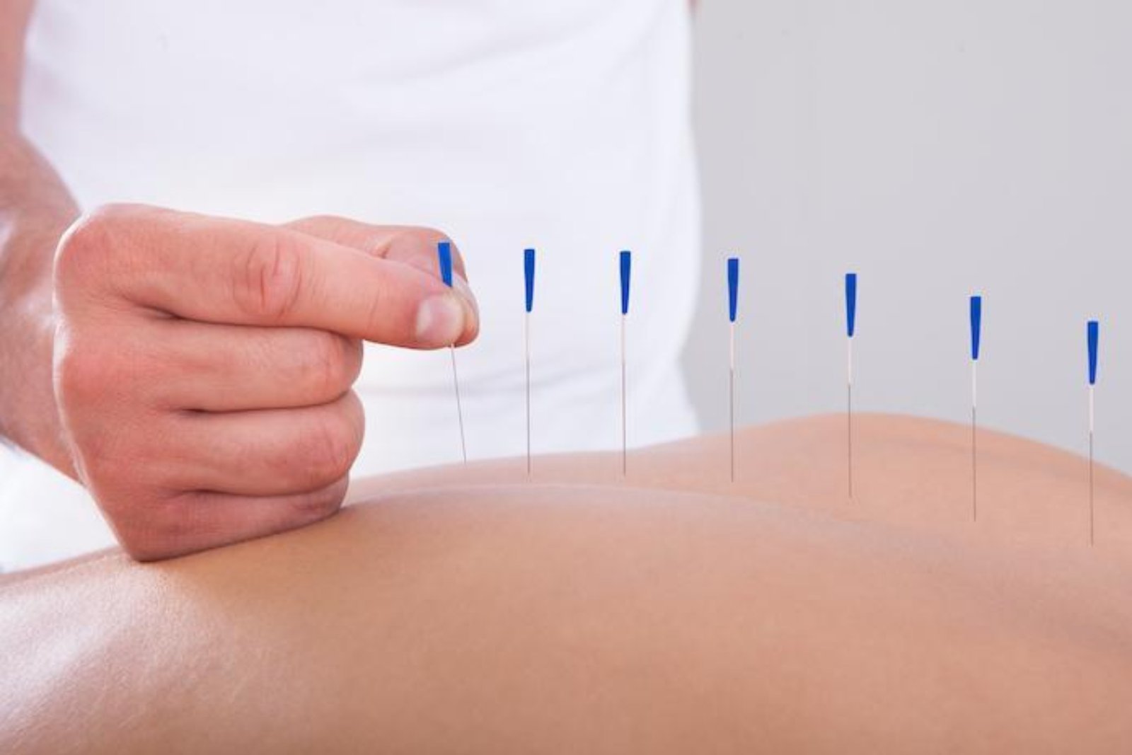 Dry Needling Therapy