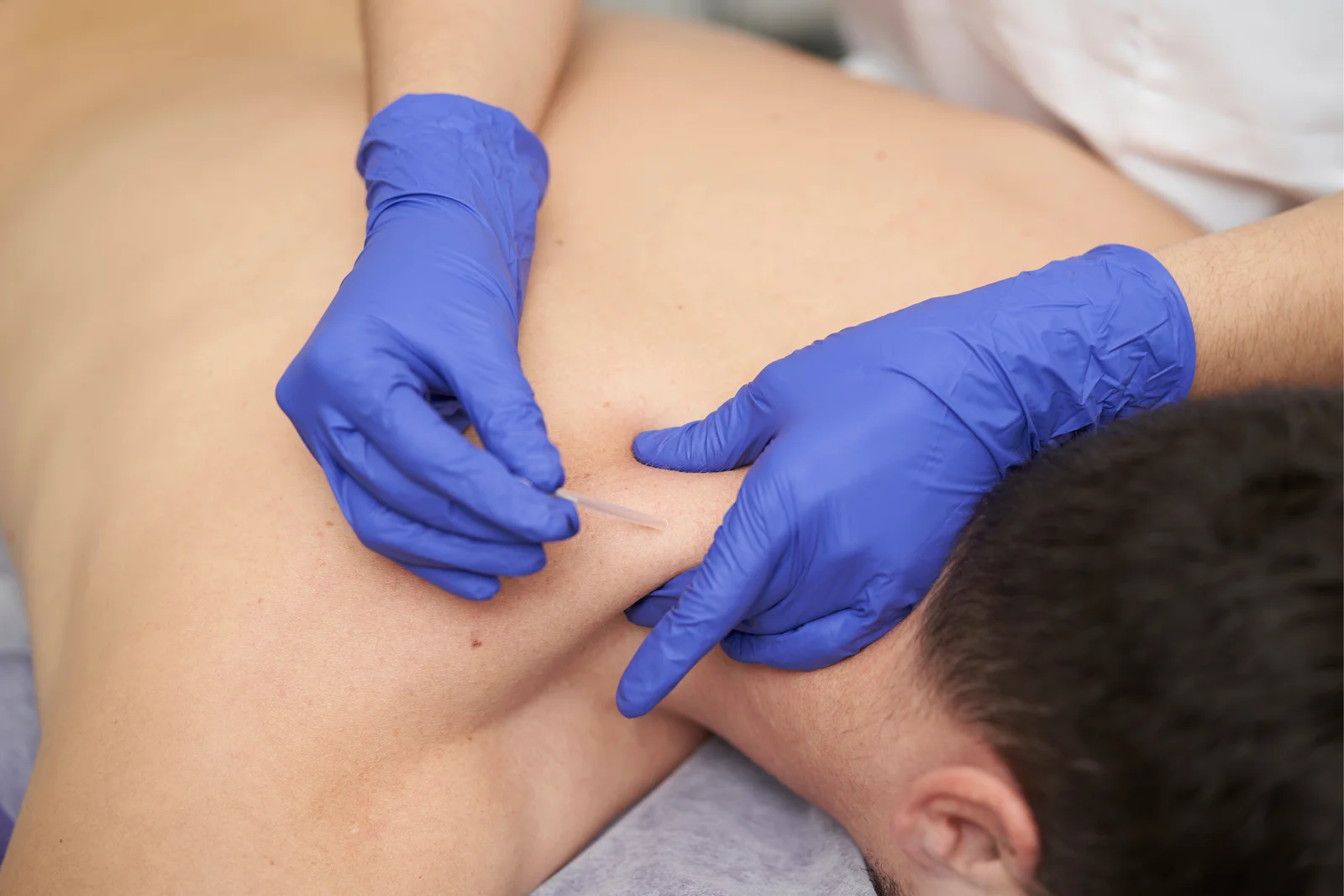 Dry Needling Therapy